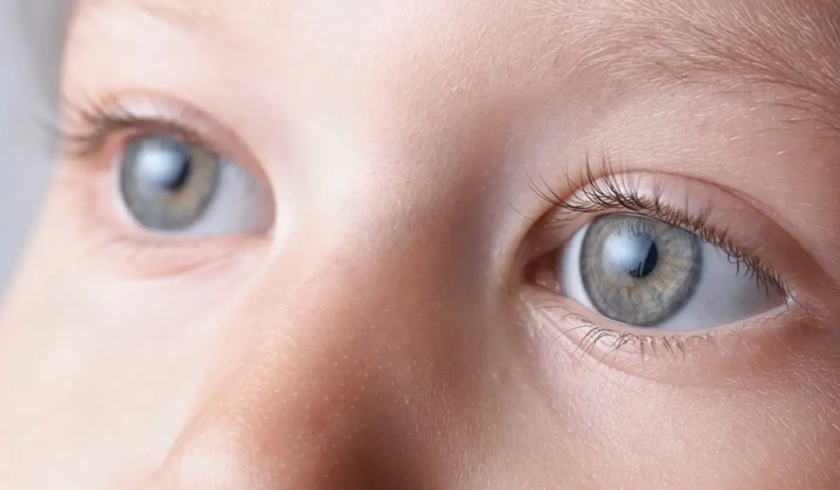 fetal alcohol syndrome eyes